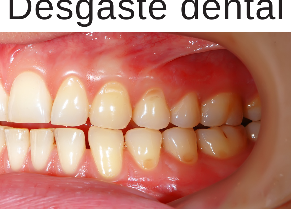 Desgaste dental