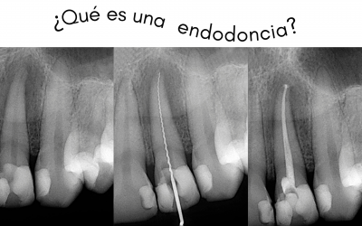¿Qué es una endodoncia?
