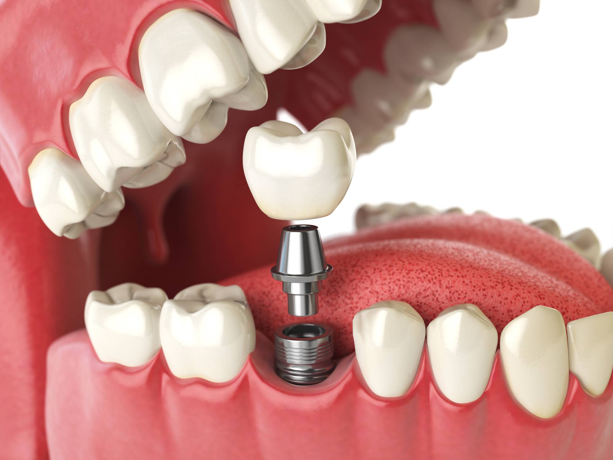 Implantes dentales en Alcorcón, Implantología Oral en Alcorcón, implantes en Alcorcón.
