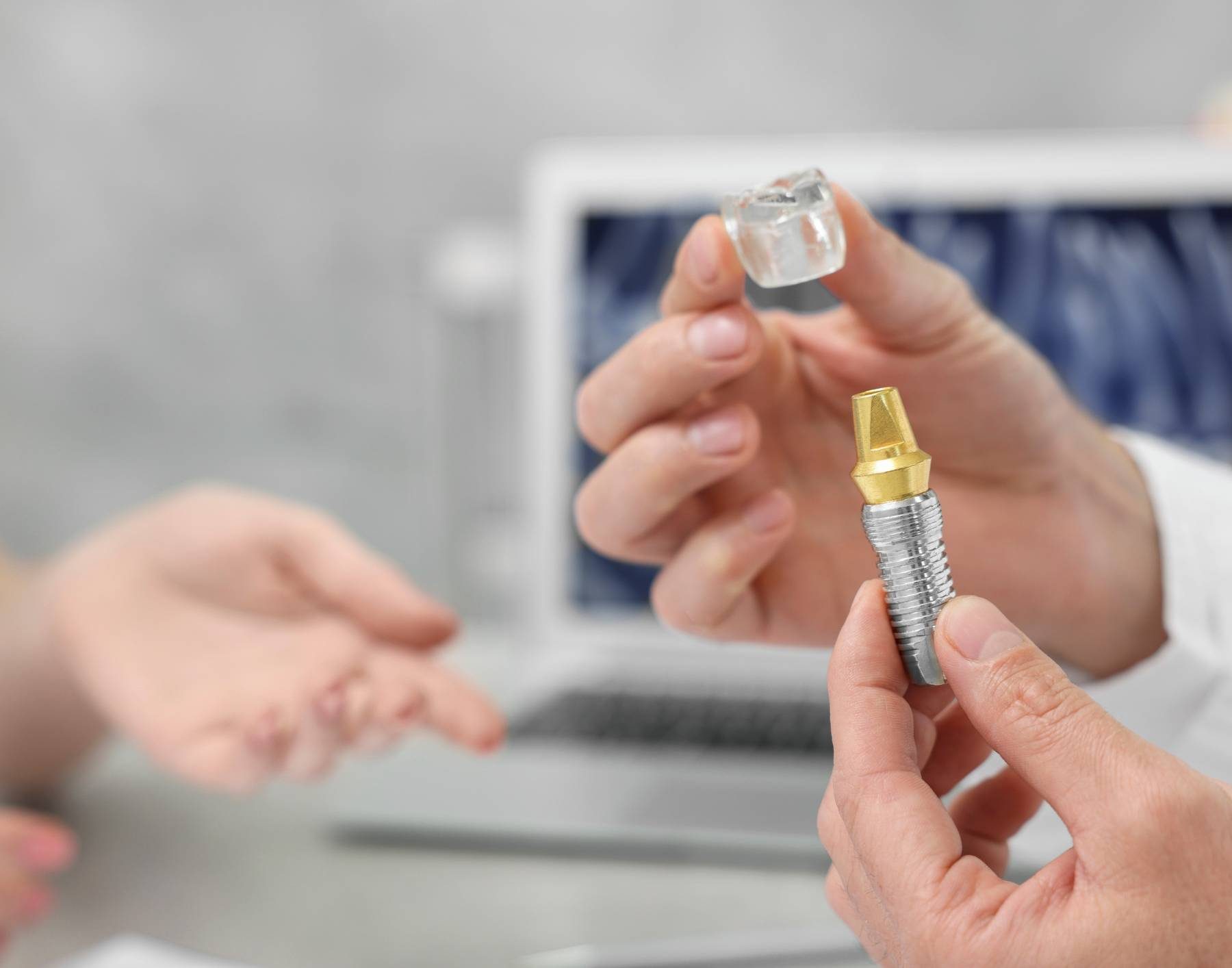 Implantes dentales en Alcorcón, Implantología Oral en Alcorcón, implantes en Alcorcón.