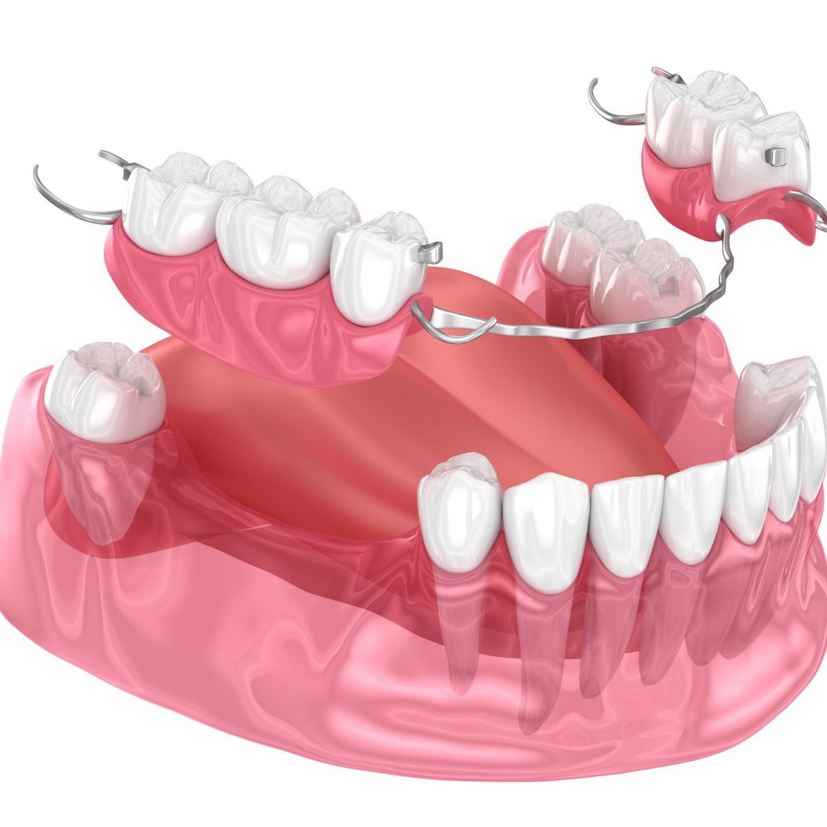 Prótesis dentales en Alcorcón, prostodoncia en Alcorcón, prótesis dentosoportadas, prótesis implantosoportadas, prótesis sobre implantes.